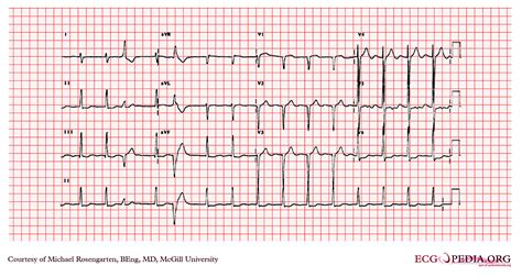 left ventricular hypertrophy ekg changes.